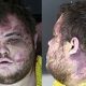 Mugshot of Colorado gay club shooting suspect shows injuries sustained during confrontation with 'heroic people'