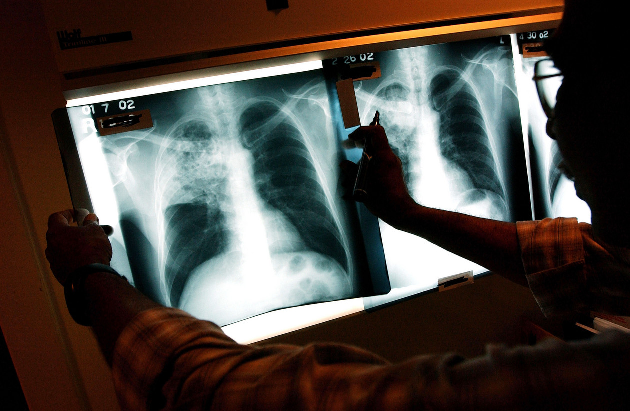 Breaking News: NYC's Race to Control Tuberculosis Surge